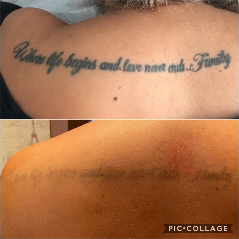 Amy Bowler tattoo removal Amy Bowler tattoo removal